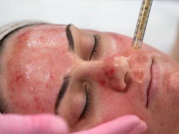 carbon-or-vampire-facials
